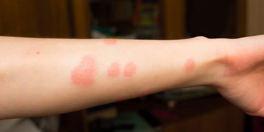 Forearm With Multiple Red, Irritated Spots, Resembling Flea Bites. The Background Is Blurred, Focusing On The Affected Skin.